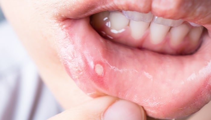 お口の中の粘膜の病気チェック